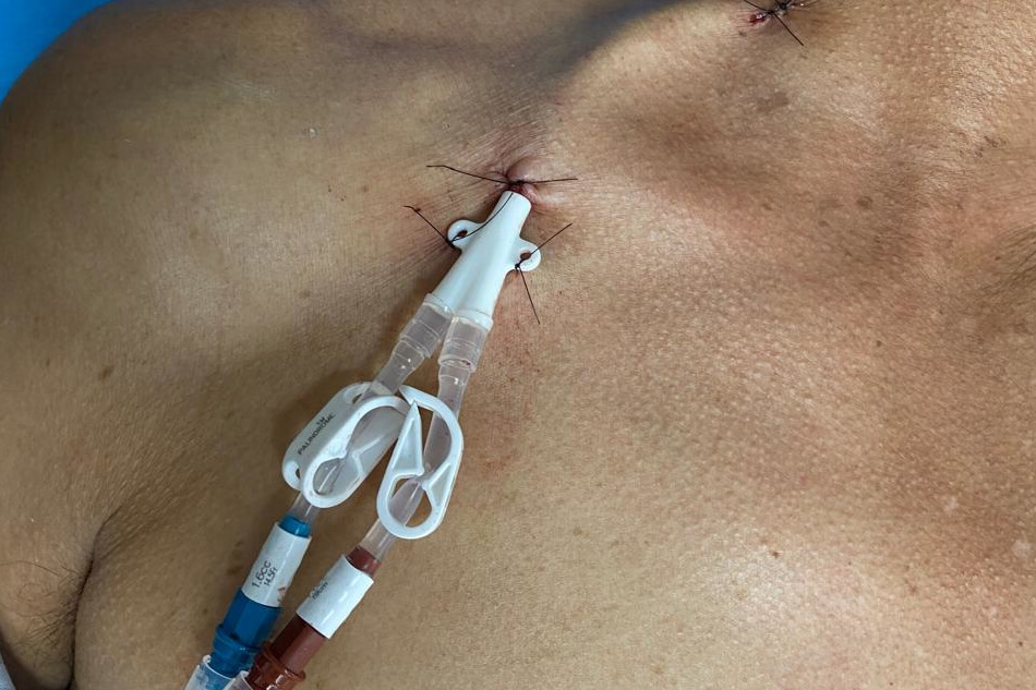 Colocación de catéter permanente de hemodiálisis